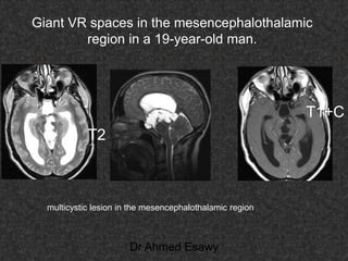 Fifteen (50) intracranial cystic lesion Dr Ahmed Esawy CT MRI main  Slide 175