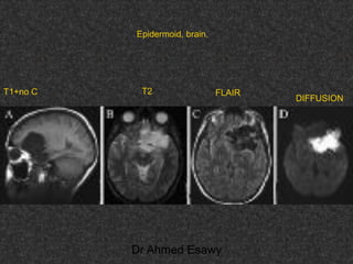 Fifteen (50) intracranial cystic lesion Dr Ahmed Esawy CT MRI main  Slide 195