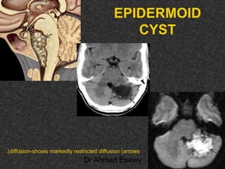 Fifteen (50) intracranial cystic lesion Dr Ahmed Esawy CT MRI main  Slide 197