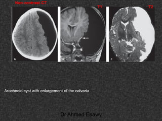 Fifteen (50) intracranial cystic lesion Dr Ahmed Esawy CT MRI main  Slide 20