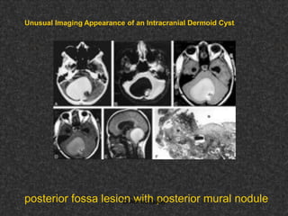 Fifteen (50) intracranial cystic lesion Dr Ahmed Esawy CT MRI main  Slide 207