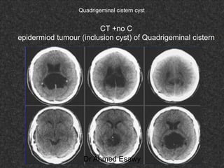 Fifteen (50) intracranial cystic lesion Dr Ahmed Esawy CT MRI main  Slide 210