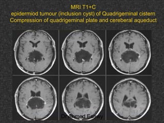 Fifteen (50) intracranial cystic lesion Dr Ahmed Esawy CT MRI main  Slide 212