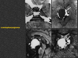 Fifteen (50) intracranial cystic lesion Dr Ahmed Esawy CT MRI main  Slide 215