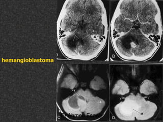 Fifteen (50) intracranial cystic lesion Dr Ahmed Esawy CT MRI main  Slide 219