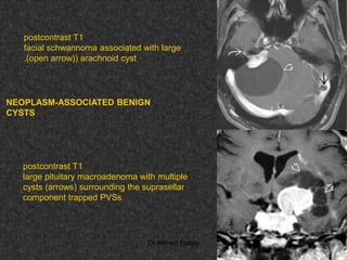 Fifteen (50) intracranial cystic lesion Dr Ahmed Esawy CT MRI main  Slide 220