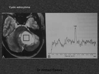 Fifteen (50) intracranial cystic lesion Dr Ahmed Esawy CT MRI main  Slide 224