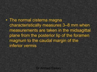 Fifteen (50) intracranial cystic lesion Dr Ahmed Esawy CT MRI main  Slide 30