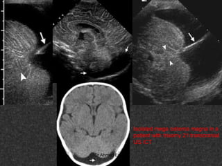 Fifteen (50) intracranial cystic lesion Dr Ahmed Esawy CT MRI main  Slide 31