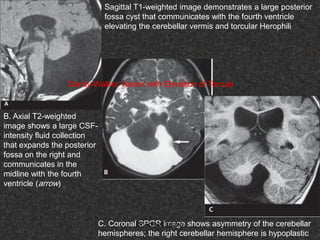 Fifteen (50) intracranial cystic lesion Dr Ahmed Esawy CT MRI main  Slide 37
