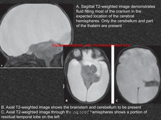 Fifteen (50) intracranial cystic lesion Dr Ahmed Esawy CT MRI main  Slide 42