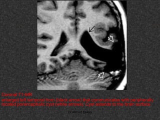 Fifteen (50) intracranial cystic lesion Dr Ahmed Esawy CT MRI main  Slide 44