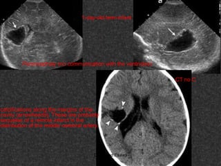 Fifteen (50) intracranial cystic lesion Dr Ahmed Esawy CT MRI main  Slide 46