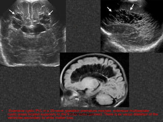Fifteen (50) intracranial cystic lesion Dr Ahmed Esawy CT MRI main  Slide 59