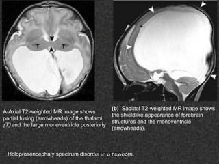 Fifteen (50) intracranial cystic lesion Dr Ahmed Esawy CT MRI main  Slide 67