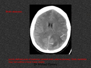 Fifteen (50) intracranial cystic lesion Dr Ahmed Esawy CT MRI main  Slide 76