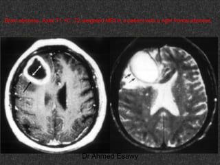 Fifteen (50) intracranial cystic lesion Dr Ahmed Esawy CT MRI main  Slide 81
