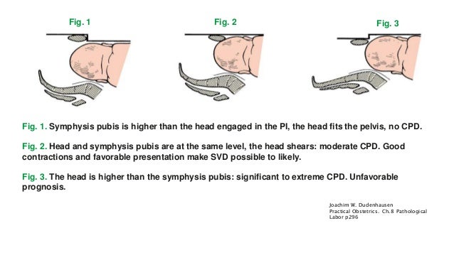 leopold maneuver