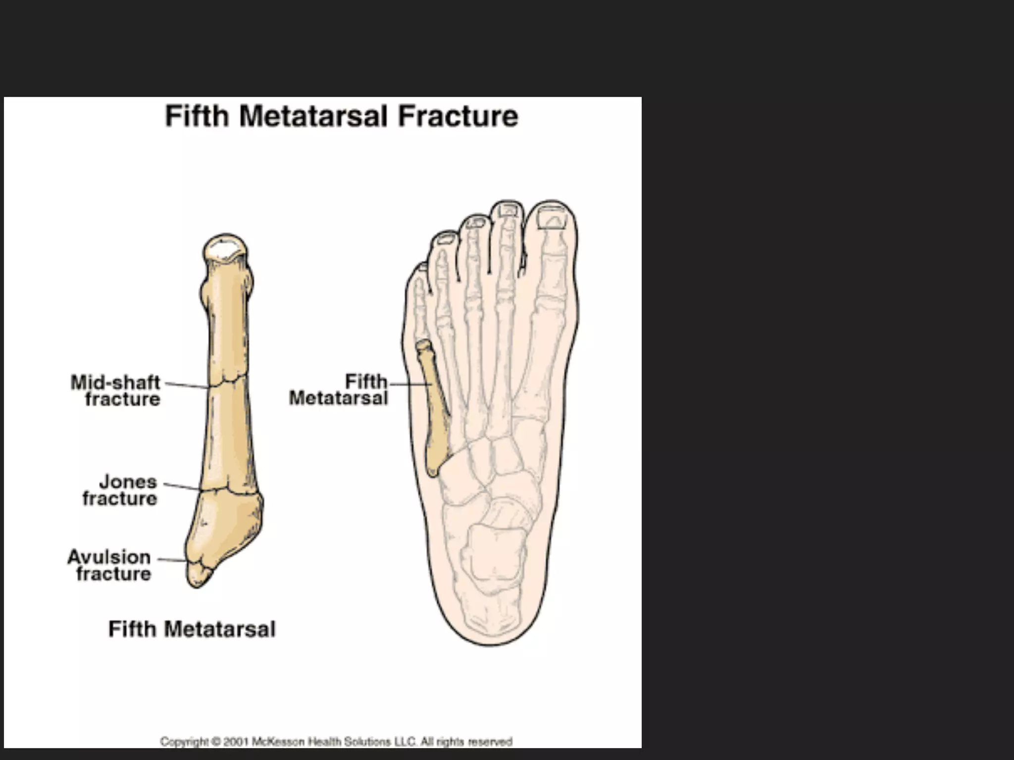 Fifth metatarsal bone fracture | PDF