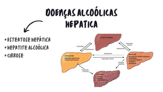 DOENÇASALCOÓLICAS
HEPATICA
•EsteatoseHepática
•HepatiteAlcoólica
•Cirrose
 