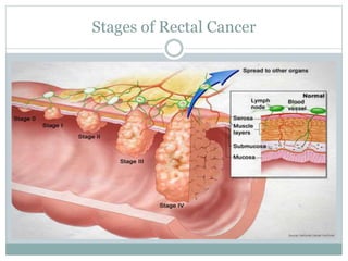 Stages of Rectal Cancer
 