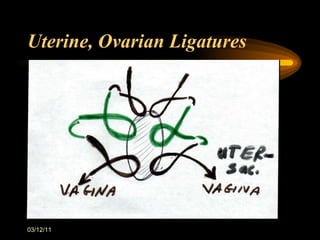Uterine, Ovarian Ligatures 03/12/11 