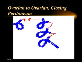 Ovarian to Ovarian, Closing Peritoneum 03/12/11 