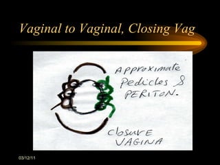 Vaginal to Vaginal, Closing Vag 03/12/11 