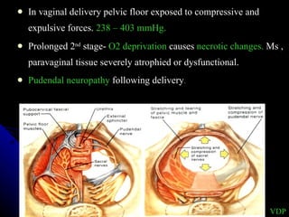 In vaginal delivery pelvic floor exposed to compressive and expulsive forces.  238 – 403 mmHg. Prolonged 2 nd  stage-  O2 deprivation  causes  necrotic changes.  Ms , paravaginal tissue severely atrophied or dysfunctional. Pudendal neuropathy  following delivery . VDP 