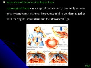 Separation of pubocervical fascia from  rectovaginal fascia  causes apical enterocoele, commonly seen in post-hysterectomy patients, hence, essential to get them together with the vaginal muscularis and the uterosacral ligs. VDP 