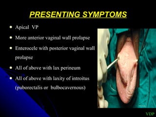 PRESENTING SYMPTOMS Apical  VP More anterior vaginal wall prolapse Enterocele with posterior vaginal wall prolapse  All of above with lax perineum All of above with laxity of introitus (puborectalis or  bulbocavernous) VDP 