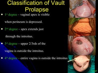 Classification of Vault  Prolapse 1 st  degree  – vaginal apex is visible  when perineum is depressed. 2 nd  degree  – apex extends just   through the introitus. 3 rd  degree  – upper 2/3rds of the  vagina is outside the introitus. 4 th  degree  – entire vagina is outside the introitus  VDP 