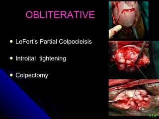 OBLITERATIVE LeFort’s Partial Colpocleisis Introital  tightening Colpectomy VDP 
