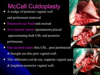McCall Culdoplasty A wedge of posterior vaginal wall  and peritoneum removed Enterocole sac freed  and excised Two internal sutures  (permanent) placed   approximating both USL and posterior  peritoneum. One external suture  thru USL , post peritoneum  & brought out thru post vaginal wall. This obliterates cul-de-sac, supports vaginal apex  & lengthens posterior vaginal wall. VDP 
