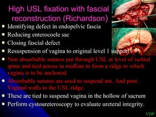 High USL fixation with fascial  reconstruction (Richardson ) Identifying defect in endopelvic fascia Reducing enterocoele sac Closing fascial defect Resuspension of vagina to original level 1 support Non absorbable sutures put through USL at level of ischial spine and tied across in midline to form a ridge to which vagina is to be anchored Absorbable sutures are used to suspend ant. And post. Vaginal walls to the USL ridge.  These are tied to suspend vagina in the hollow of sacrum Perform cystoureteroscopy to evaluate ureteral integrity. VDP 