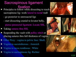 Sacrospinous ligament  fixation Principles to follow while dissecting to reach sacrospinous lig- work  lateral to rectal  wall - go posterior to uterosacral ligs - start dissecting cranial to levator belly, pierce pararectal ligament. Locate SSL. Taking  sutures thru SSL Suspending the vault with  pulley stitch  or placing sutures thru full thickness of vagina. Other Pexy : vagina to pelvic fasc: Shull, Vagina to sacrotuberous : Amreich Vagina to arcus tendinous : White Vagina to sacrospinous lig: Richter VDP 