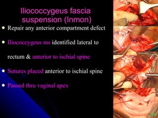 Iliococcygeus fascia  suspension (Inmon) Repair any anterior compartment defect  Iliococcygeus ms  identified lateral to  rectum &  anterior to ischial spine Sutures placed  anterior to ischial spine  Passed thru vaginal apex VDP 