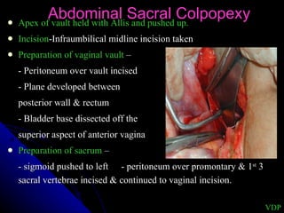 Apex of vault held with Allis and pushed up. Incision -Infraumbilical midline incision taken  Preparation of vaginal vault  – - Peritoneum over vault incised - Plane developed between  posterior wall & rectum  - Bladder base dissected off the  superior aspect of anterior vagina Preparation of sacrum  – - sigmoid pushed to left - peritoneum over promontary & 1 st  3 sacral vertebrae incised & continued to vaginal incision. Abdominal Sacral Colpopexy VDP 