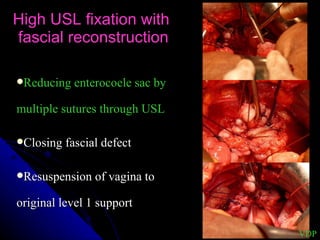 High USL fixation with  fascial reconstruction Reducing enterocoele sac by multiple sutures through USL Closing fascial defect Resuspension of vagina to original level 1 support VDP 