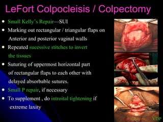 LeFort Colpocleisis / Colpectomy Small Kelly’s Repair —SUI Marking out rectangular / triangular flaps on  Anterior and posterior vaginal walls Repeated  sucessive stitches to invert  the tissues Suturing of uppermost horizontal part  of rectangular flaps to each other with  delayed absorbable sutures. Small P repair , if necessary To supplement , do  introital tightening  if extreme laxity VDP 