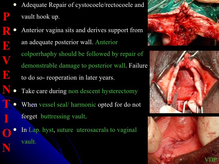 Best of Vaginal hysterectomy ap repair Hardcore anal creampie compilation