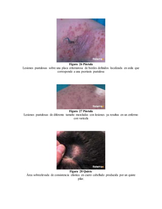Figura 26 Pústula
Lesiones pustulosas sobre una placa eritematosa de bordes definidos localizada en axila que
corresponde a una psoriasis pustulosa
Figura 27 Pústula
Lesiones pustulosas de diferente tamaño mezcladas con lesiones ya resultas en un enfermo
con varicela
Figura 28 Quiste
Área sobreelevada de consistencia elástica en cuero cabelludo producida por un quiste
pilar.
 