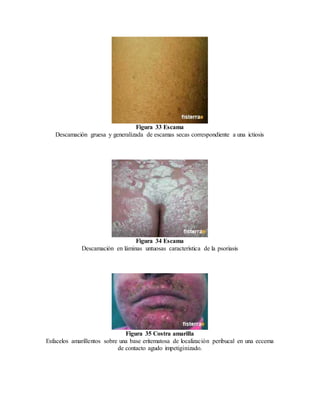 Figura 33 Escama
Descamación gruesa y generalizada de escamas secas correspondiente a una ictiosis
Figura 34 Escama
Descamación en láminas untuosas característica de la psoriasis
Figura 35 Costra amarilla
Esfacelos amarillentos sobre una base eritematosa de localización peribucal en una eccema
de contacto agudo impetiginizado.
 