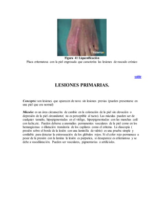 Figura 41 Liquenificación
Placa eritematosa con la piel engrosada que caracteriza las lesiones de rascado crónico
subir
LESIONES PRIMARIAS.
Concepto: son lesiones que aparecen de novo sin lesiones previas (pueden presentarse en
una piel que era normal)
Mácula: es un área circunscrita de cambio en la coloración de la piel sin elevación o
depresión de la piel circundante( no es perceptible al tacto). Las máculas pueden ser de
cualquier tamaño, hipopigmentadas en el vitiligo, hiperpigmentadas con las manchas café
con leche,etc. Pueden deberse a anomalías permanentes vasculares de la piel como en los
hemangiomas o dilatación transitoria de los capilares como el eritema. La diascopia (
presión sobre el borde de la lesión con una laminilla de vidrio) es una prueba simple y
confiable para detectar la extravasación de los glóbulos rojos. Si el color rojo permanece a
pesar de la presión con la lamina la lesión es purpurica, si desaparece es eritematosa y se
debe a vasodilatación. Pueden ser vasculares, pigmentarias o artificiales.
 