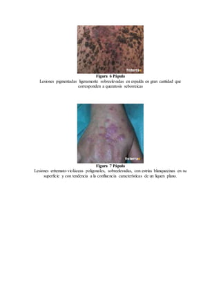 Figura 6 Pápula
Lesiones pigmentadas ligeramente sobreelevadas en espalda en gran cantidad que
corresponden a queratosis seborreicas
Figura 7 Pápula
Lesiones eritemato-violáceas poligonales, sobreelevadas, con estrías blanquecinas en su
superficie y con tendencia a la confluencia características de un liquen plano.
 