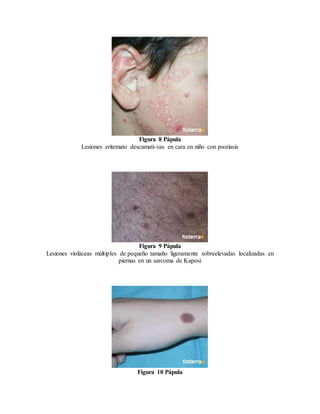Figura 8 Pápula
Lesiones eritemato descamati-vas en cara en niño con psoriasis
Figura 9 Pápula
Lesiones violáceas múltiples de pequeño tamaño ligeramente sobreelevadas localizadas en
piernas en un sarcoma de Kaposi
Figura 10 Pápula
 
