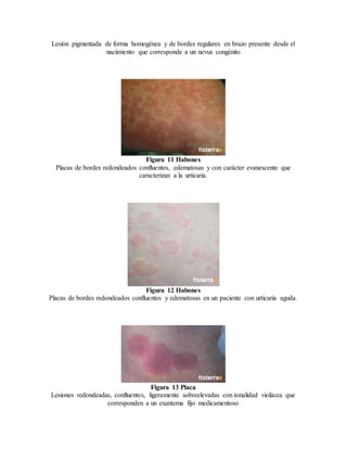 Lesión pigmentada de forma homogénea y de bordes regulares en brazo presente desde el
nacimiento que corresponde a un nevus congénito
Figura 11 Habones
Placas de bordes redondeados confluentes, edematosas y con carácter evanescente que
caracterizan a la urticaria.
Figura 12 Habones
Placas de bordes redondeados confluentes y edematosas en un paciente con urticaria aguda.
Figura 13 Placa
Lesiones redondeadas, confluentes, ligeramente sobreelevadas con tonalidad violácea que
corresponden a un exantema fijo medicamentoso
 