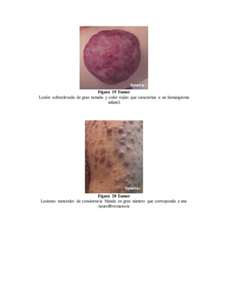 Figura 19 Tumor
Lesión sobreelevada de gran tamaño y color rojizo que caracteriza a un hemangioma
infantil
Figura 20 Tumor
Lesiones tumorales de consistencia blanda en gran número que corresponde a una
neurofibromatosis
 