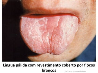 Língua pálida com revestimento coberto por flocos
                     brancos    Profª Karen Fernandes Andrade
 