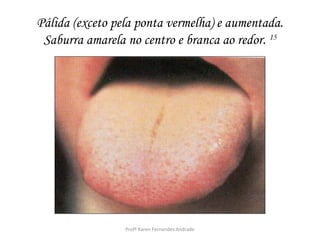 Pálida (exceto pela ponta vermelha) e aumentada.
 Saburra amarela no centro e branca ao redor. 15




                 Profª Karen Fernandes Andrade
 